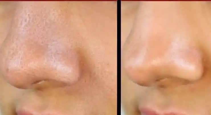 Gözenekli Burun Nasıl Gelişmiş Bakım ve Estetik Yöntemlerle İyileştirilir