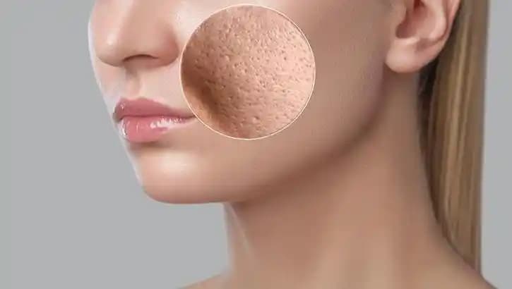 Gözenekli Cilt Bakımı ve Doğru Ürün Seçimi İpuçlarıyla Sağlıklı Cilt Yaratın