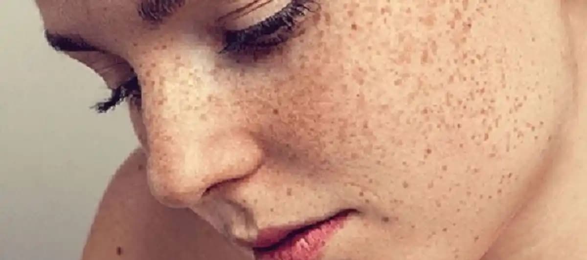 Güneş Lekeleri Neden Oluşur, Nasıl Korunulur ve Tedavi Yöntemleri Nelerdir