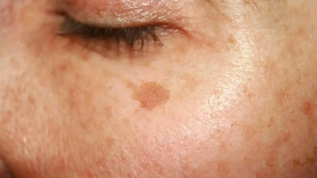 Güneş Lekeleri Nedir, Neden Oluşur ve Etkili Tedavi Yöntemleri Nelerdir