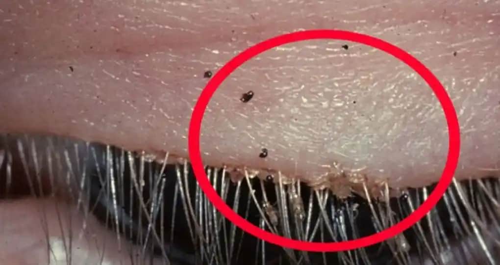 Kasık Biti Tedavisinde Kullanılan Etkili ve Güvenli İlaçlar Hakkında Bilgiler