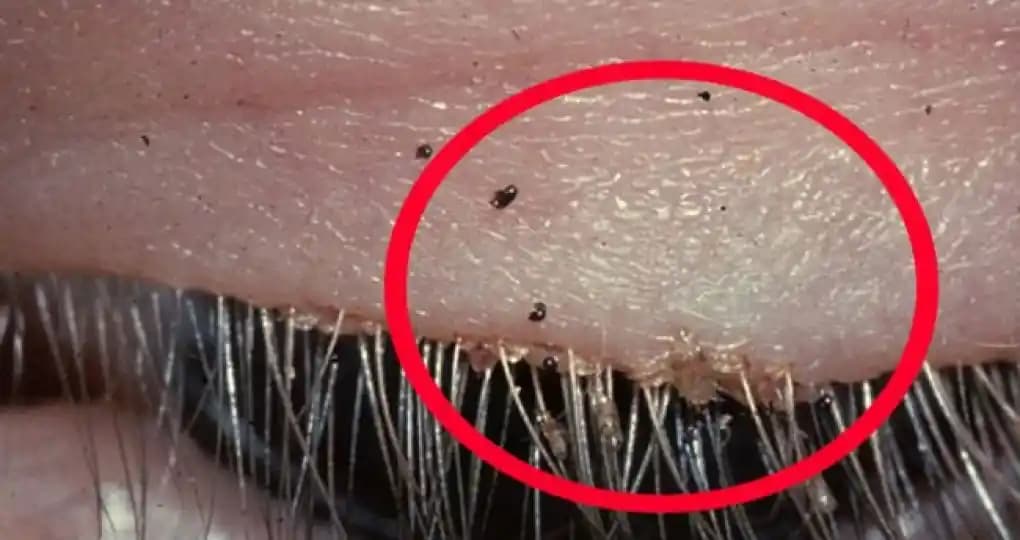 Kasık Biti Tedavisinde Kullanılan Etkili ve Güvenli İlaçlar Hakkında Bilgiler