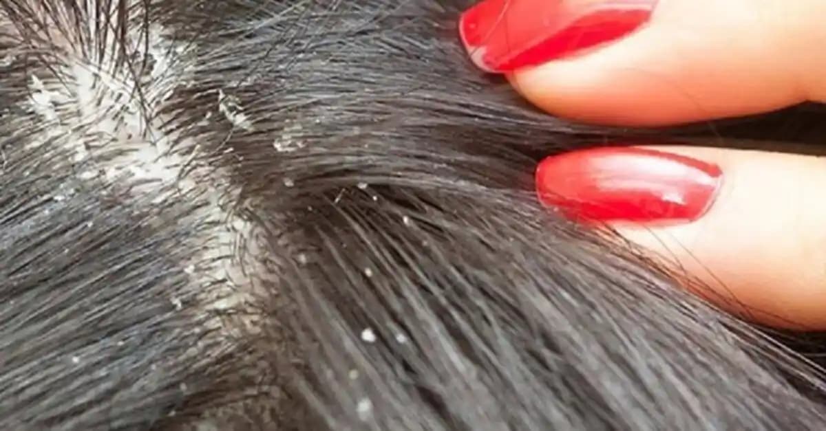 Kepeğe Karşı Etkili Yöntemler ve Sağlıklı Saçlar İçin Uzman Tavsiyeleri