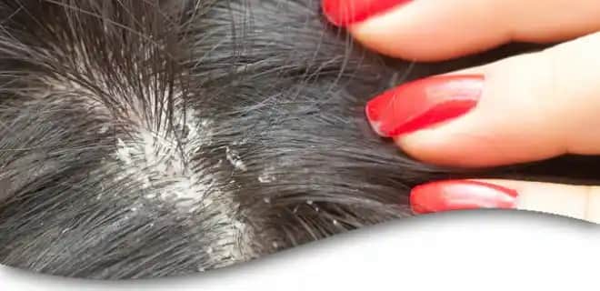 Kepekli Saçlar ve Doğru Bakım Yöntemleri: Sağlıklı ve Kepeksiz Saçlar İçin Rehber