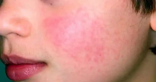 Kızarık Yüz Sorunu ve Etkili Çözüm Yolları: Cilt Bakımında Bilinçli Yaklaşımlar