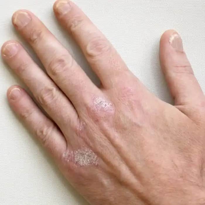 Kuru Cilt Sorunu ve Etkili Bakım Yöntemleri: Uzman Tavsiyeleri ve Doğal Çözümler