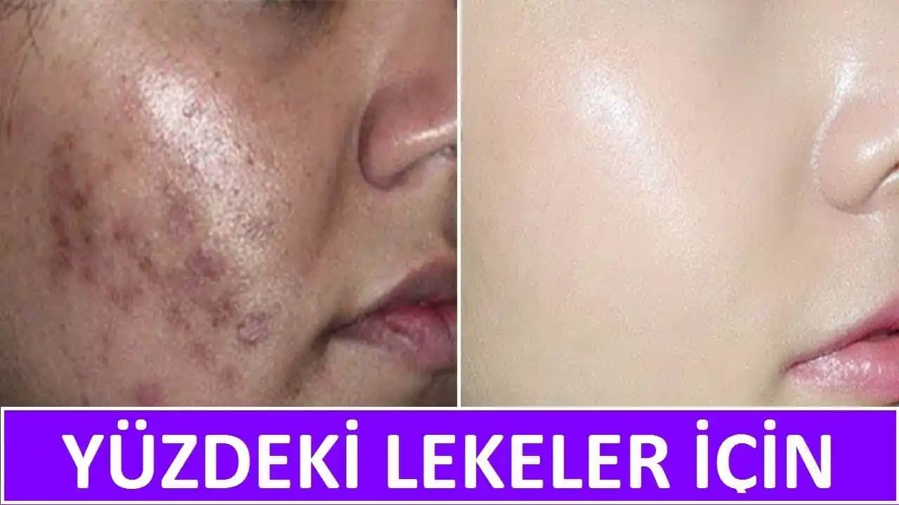 Lekeli Cilde Etkili Çözüm Yolları ve Cilt Sağlığını Destekleyen Tavsiyeler