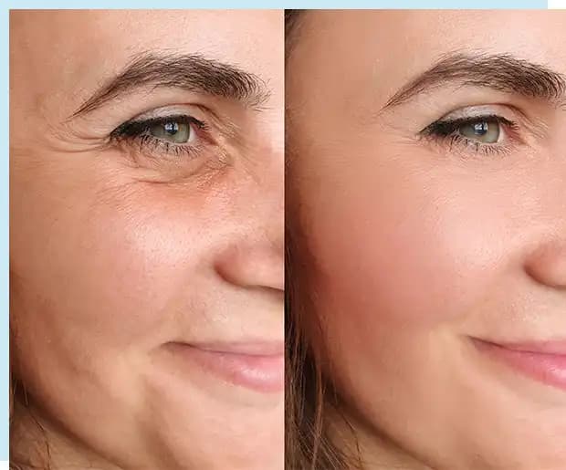 Mesolift Nedir Cilt Yenileme ve Gençleştirme İçin Modern Bir Yöntem
