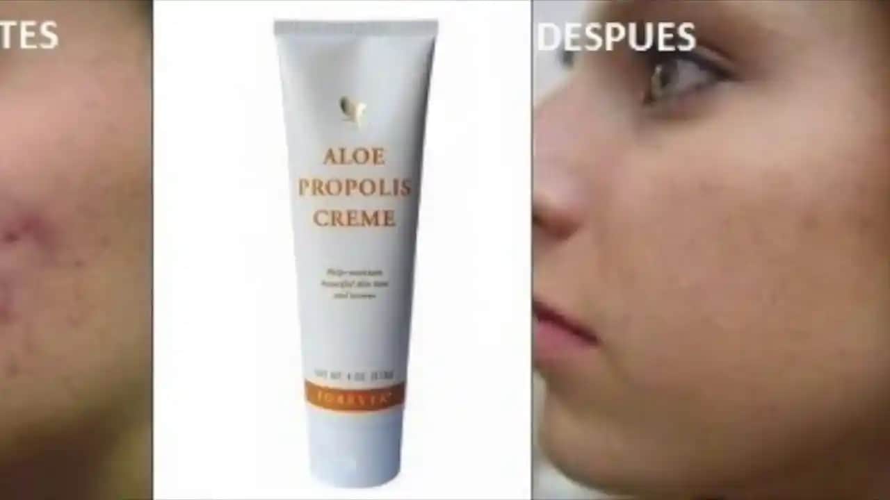 Propolis ve Sivilce: Doğal Çözüm mü Yoksa Yan Etkileri mi Var