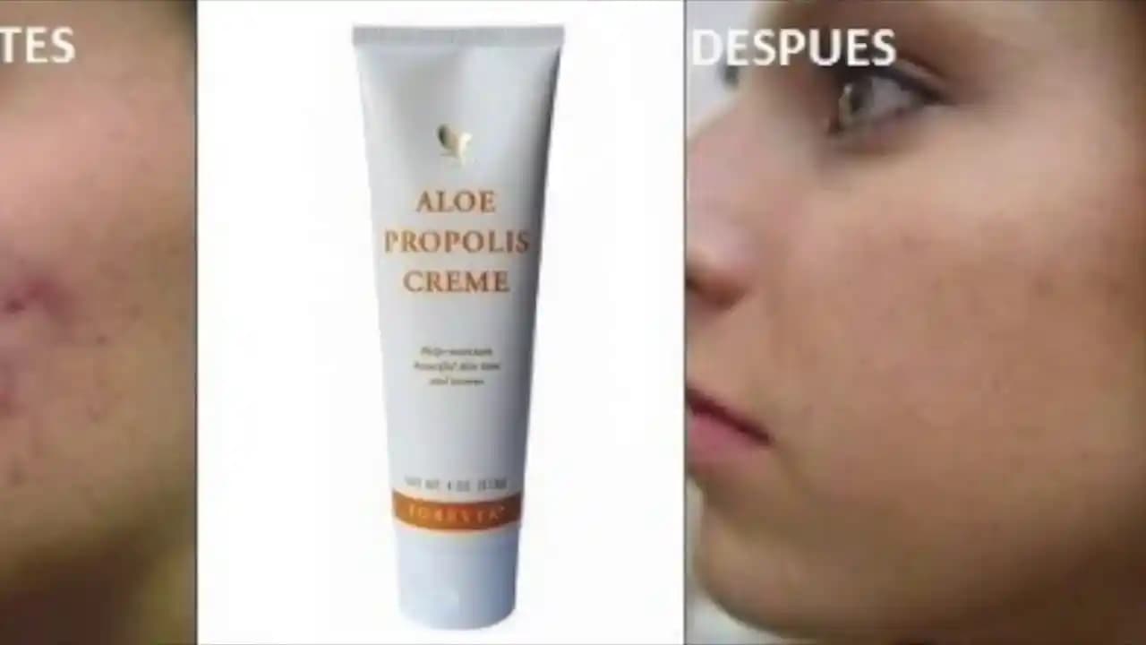 Propolis ve Sivilce: Doğal Çözüm mü Yoksa Yan Etkileri mi Var