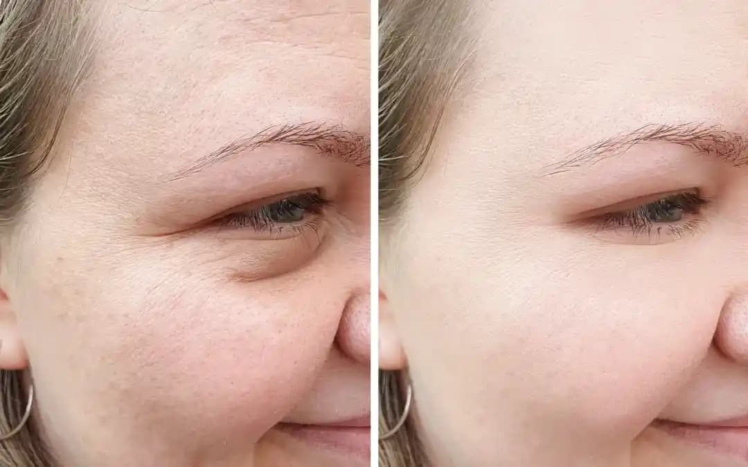 Reçeteli Retinoid Kremler: Cilt Sağlığında Etkili ve Güvenli Kullanım Rehberi