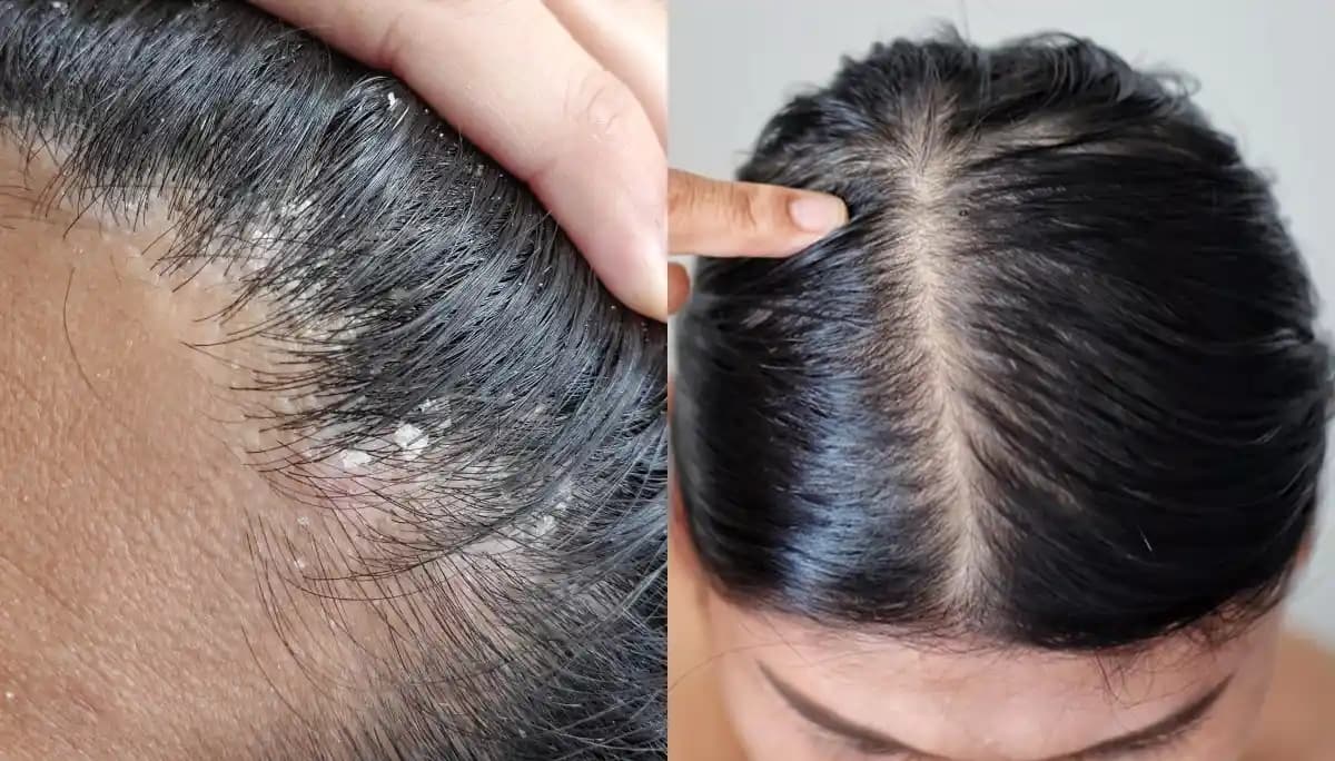 Saç Derisinin Kuruması Nedenleri Belirtileri ve Etkili Çözüm Yöntemleri