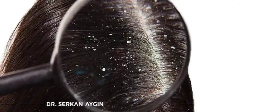 Saç Dibi Kepeklenmesi Nedenleri ve Etkili Çözüm Yöntemleri Rehberi