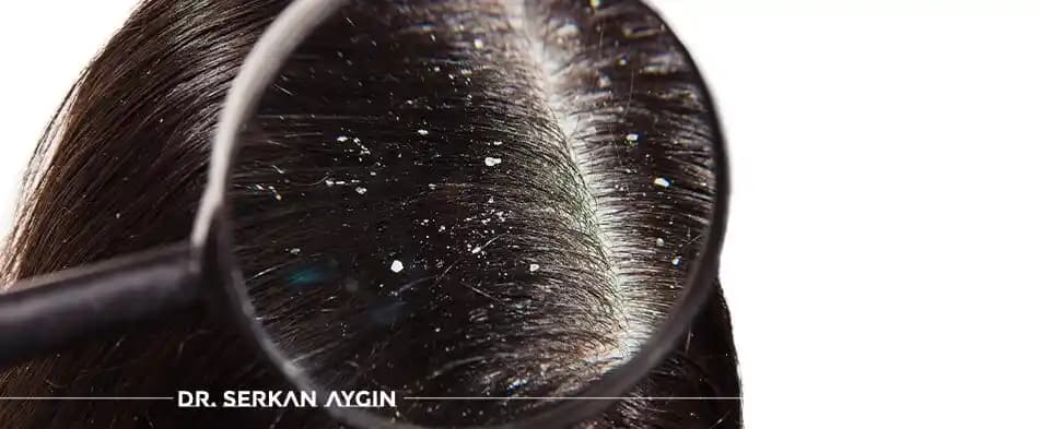 Saç Dibi Kepeklenmesi Nedenleri ve Etkili Çözüm Yöntemleri Rehberi