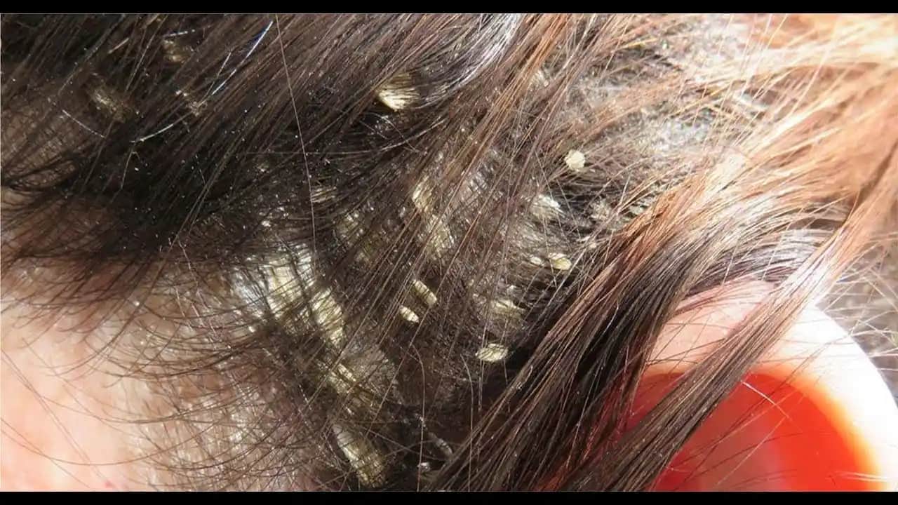 Saçta Kepek Nedenleri ve Etkili Çözüm Yolları Hakkında Kapsamlı Bilgi