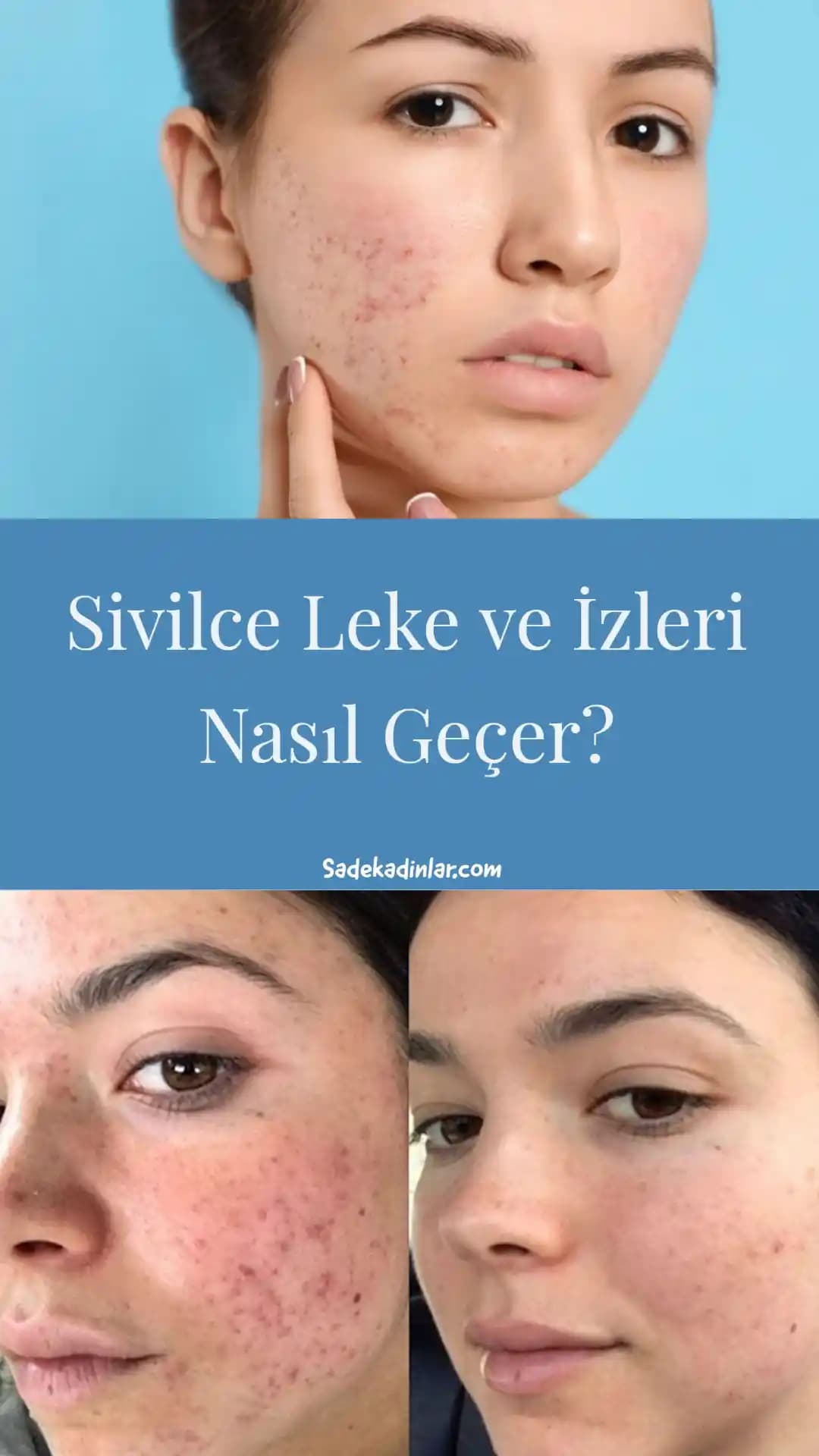 Sivilce Lekeleri Ne Kadar Sürede Geçer? Cilt Bakımı ve Tedavi Yöntemleri Rehberi