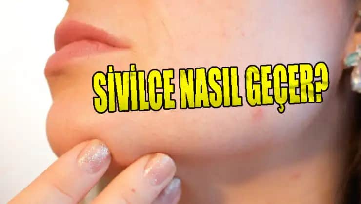 Sivilce Lekeleri Ne Kadar Sürede Geçer: Etkili Tedavi Yöntemleri ve Süreçler