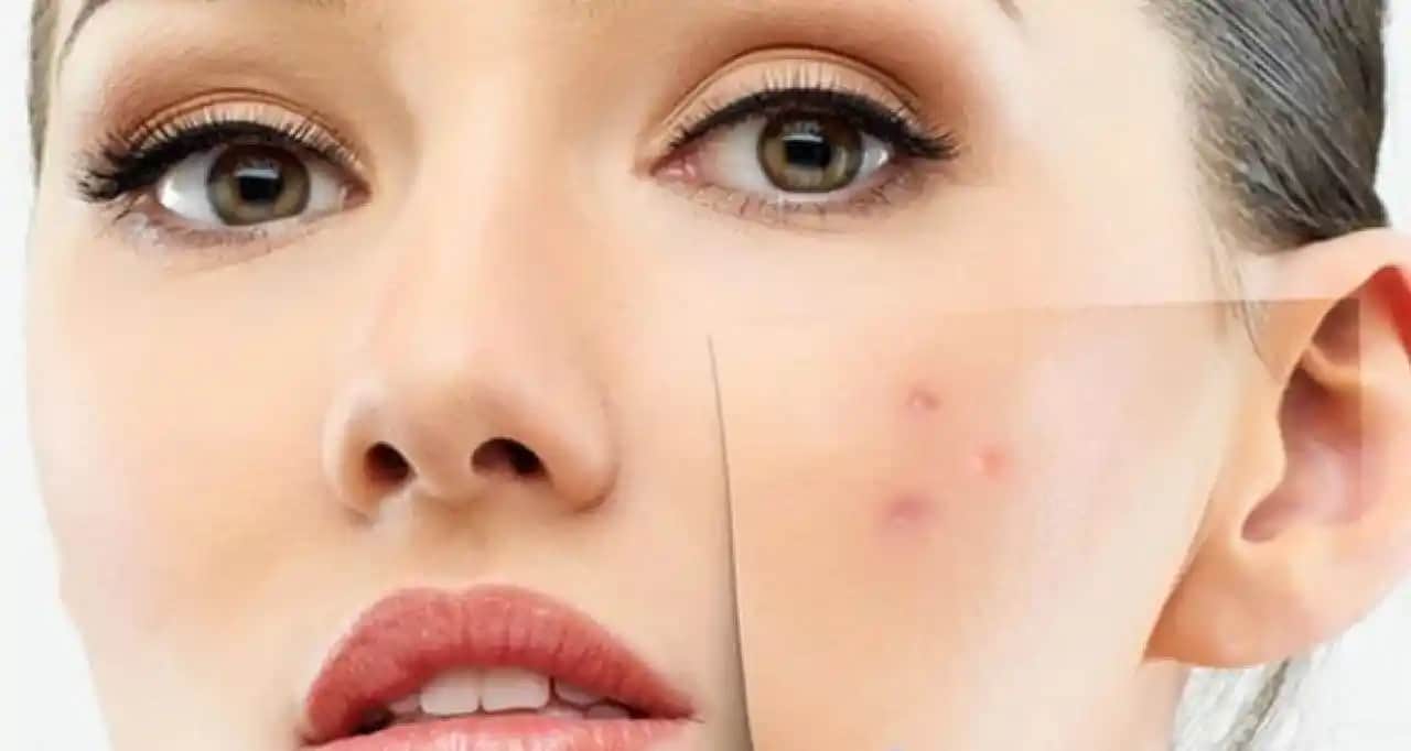 Sivilce Ne Kadar Sürede Geçer? Doğru Bakım ve Sabırla Cilt Sağlığınızı Koruyun