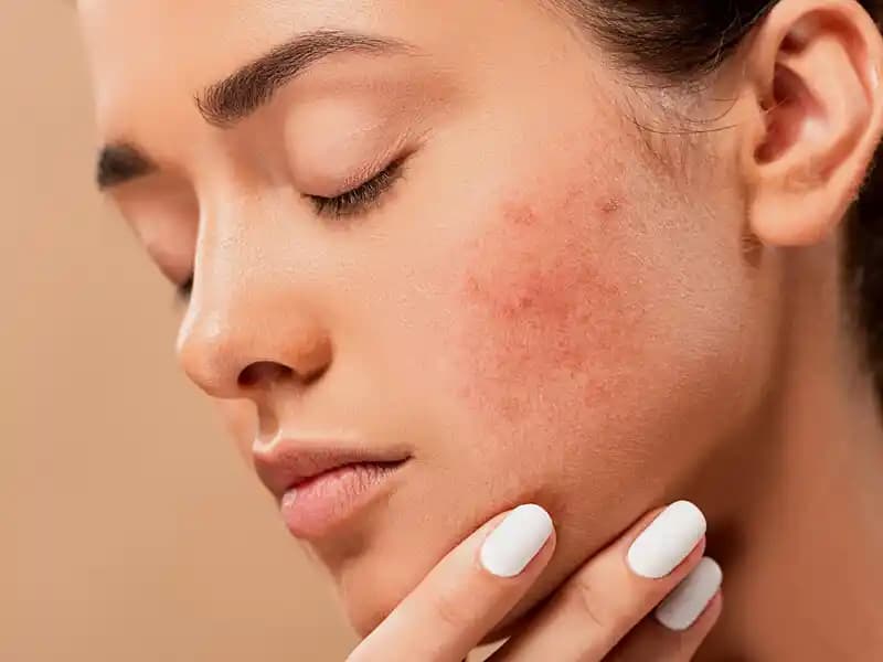 Sivilce Sonrası Kırmızı Lekelerin Giderilmesi ve Cilt Sağlığını Koruma Yöntemleri
