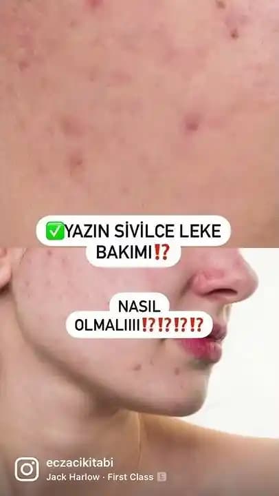 Sivilce Sonrası Lekeleri Azaltıcı Etkili Yöntemler ve Cilt Bakım İpuçları