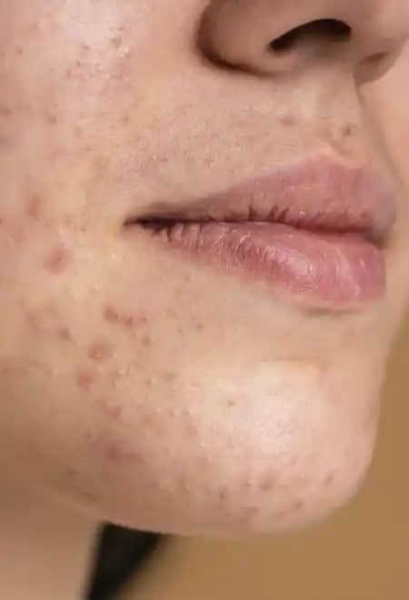 Sivilce Sonrası Siyah Lekeleri Azaltma Yöntemleri ve Cilt Bakım İpuçları