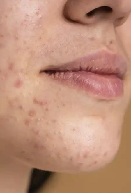 Sivilce Sonrası Siyah Lekeleri Azaltma Yöntemleri ve Cilt Bakım İpuçları