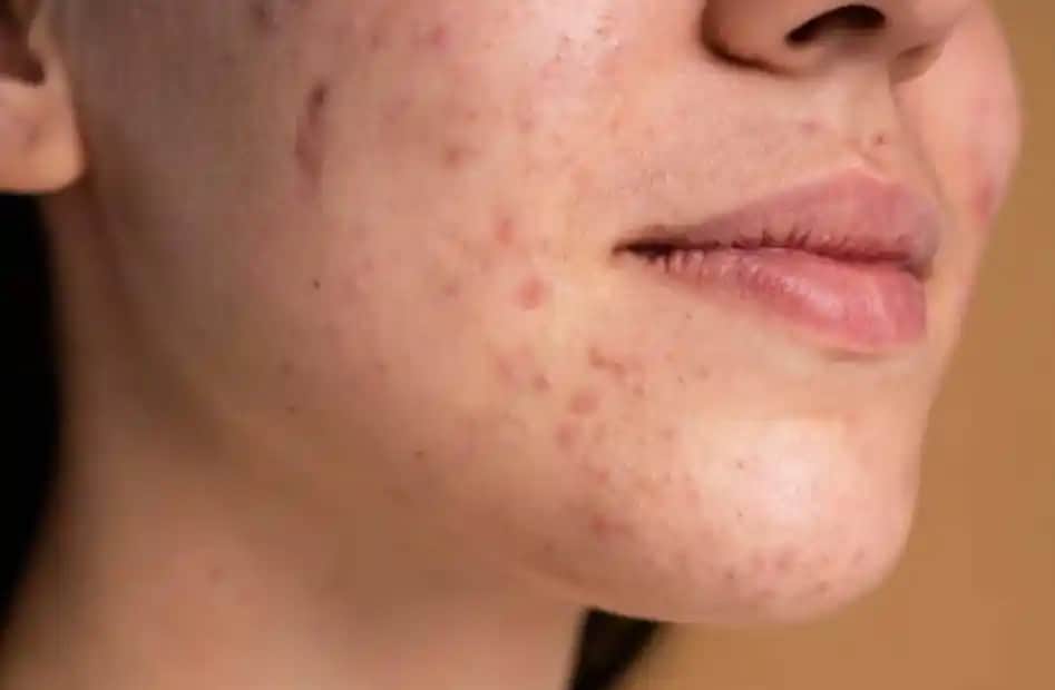 Sivilceleri Azaltmak İçin Bilimsel Temelli Etkili Bakım Yöntemleri ve İpuçları