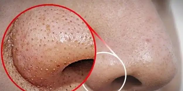 Siyah Noktalar ve Gözenekler: Etkili Temizlik ve Bakım Yöntemleri