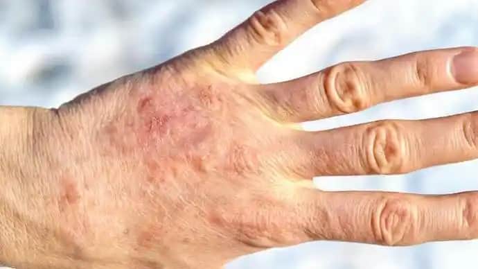 Soğuktan El Çatlaması Nedenleri Belirtileri ve Etkili Çözüm Yolları