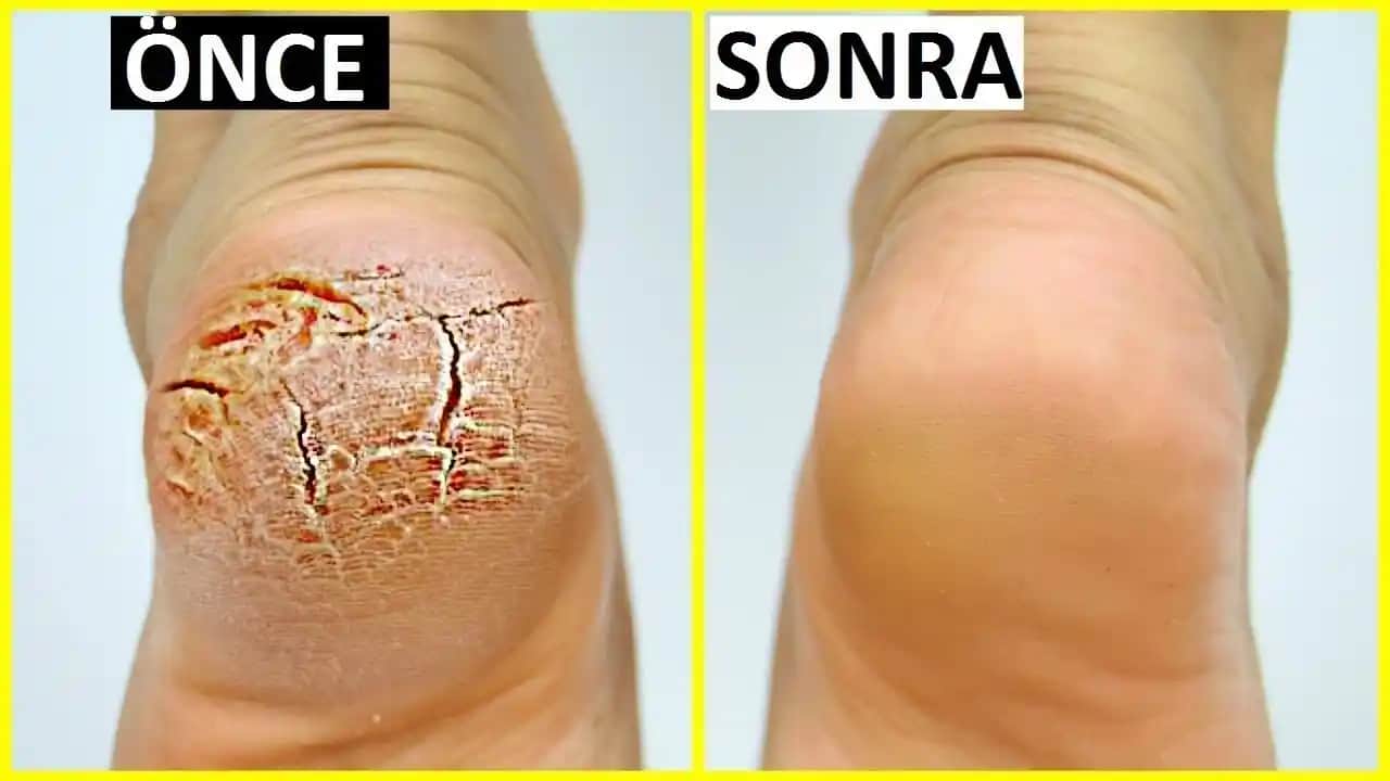 Topuk Çatlaması Nedenleri, Tedavi Yöntemleri ve Koruyucu İpuçları