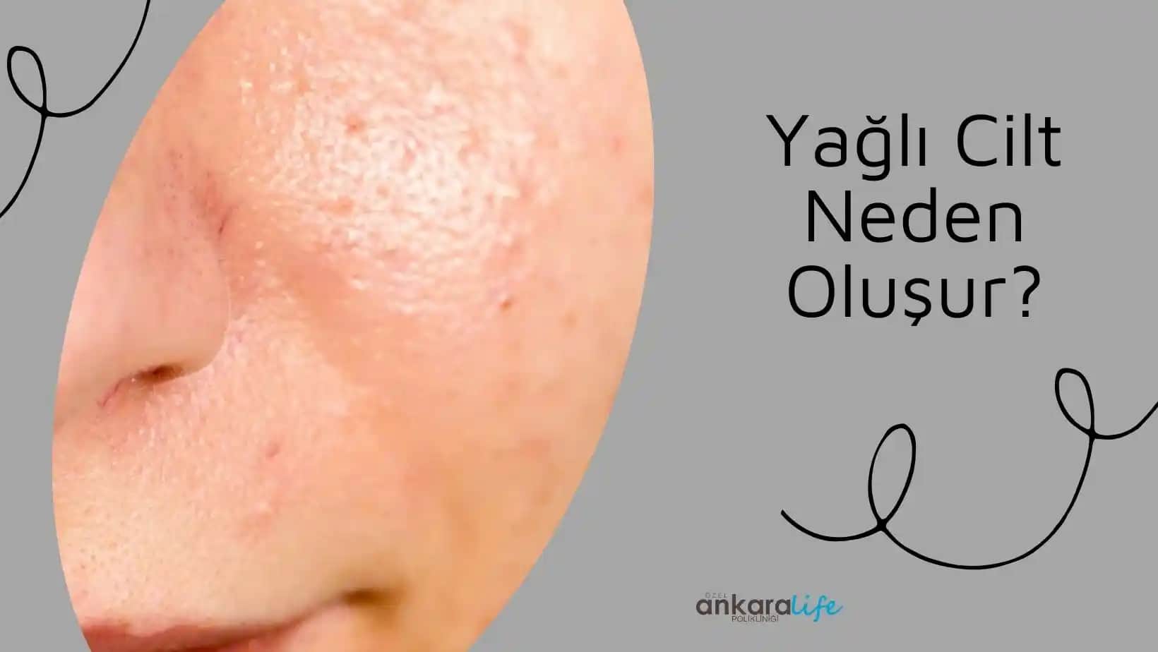 Yağlı Cilt Nedenleri ve Alınabilecek Etkili Bakım Yöntemleri