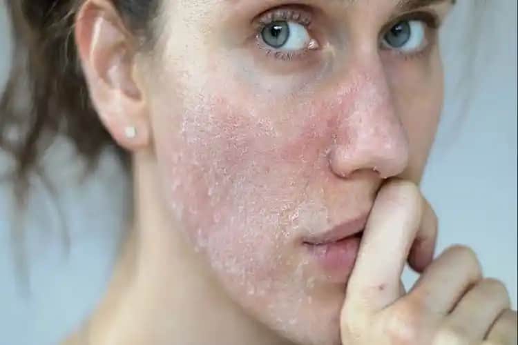 Yüz Cilt Kuruluğuna Karşı Etkili Bakım Yöntemleri ve Nemlendirme İpuçları