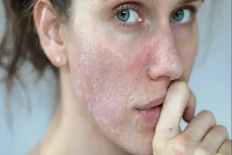 Yüz Cilt Kuruluğuna Karşı Etkili Bakım Yöntemleri ve Nemlendirme İpuçları