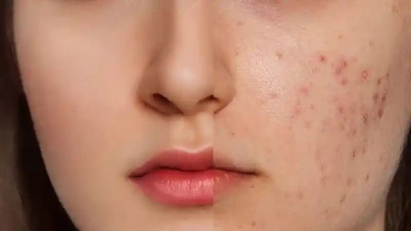 Yüz Sivilcesi Nedenleri, Tedavi Yöntemleri ve Korunma İpuçları