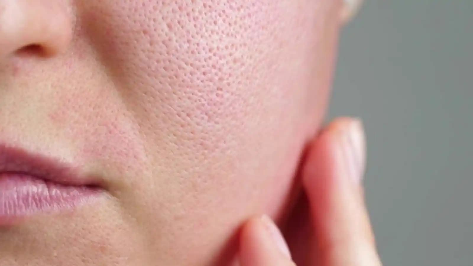 Yüzdeki Gözeneklerin Büyüme Nedenleri ve Etkili Cilt Bakım Yöntemleri Hakkında Kapsamlı Bilgi
