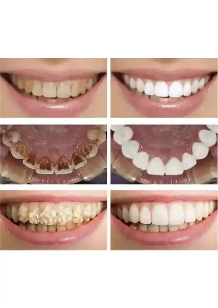 Lanbena Diş Taşı Temizleme Çubuğu: Kullanım, Etkiler ve Kullanıcı Deneyimlerinin İncelenmesi