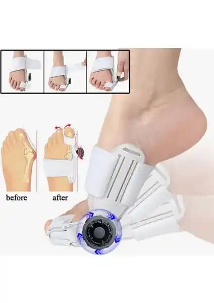 MedLon Halluks Ayak Baş Parmak Çıkıntısı Tedavisi: Güvenilir ve Etkili Bir Çözüm