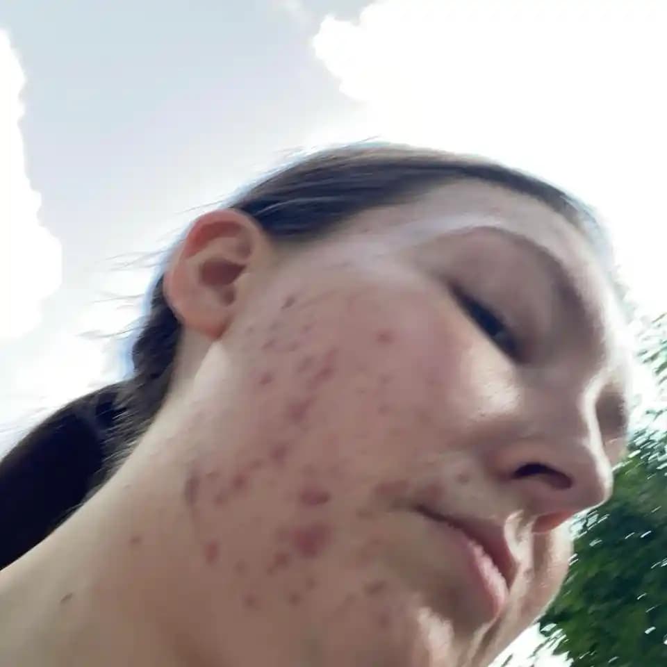 Adapalene ve Nemlendiricilerle Yağlı Cilt Bakımı: Etkili ve Dengeli Bir Rutin Örneği