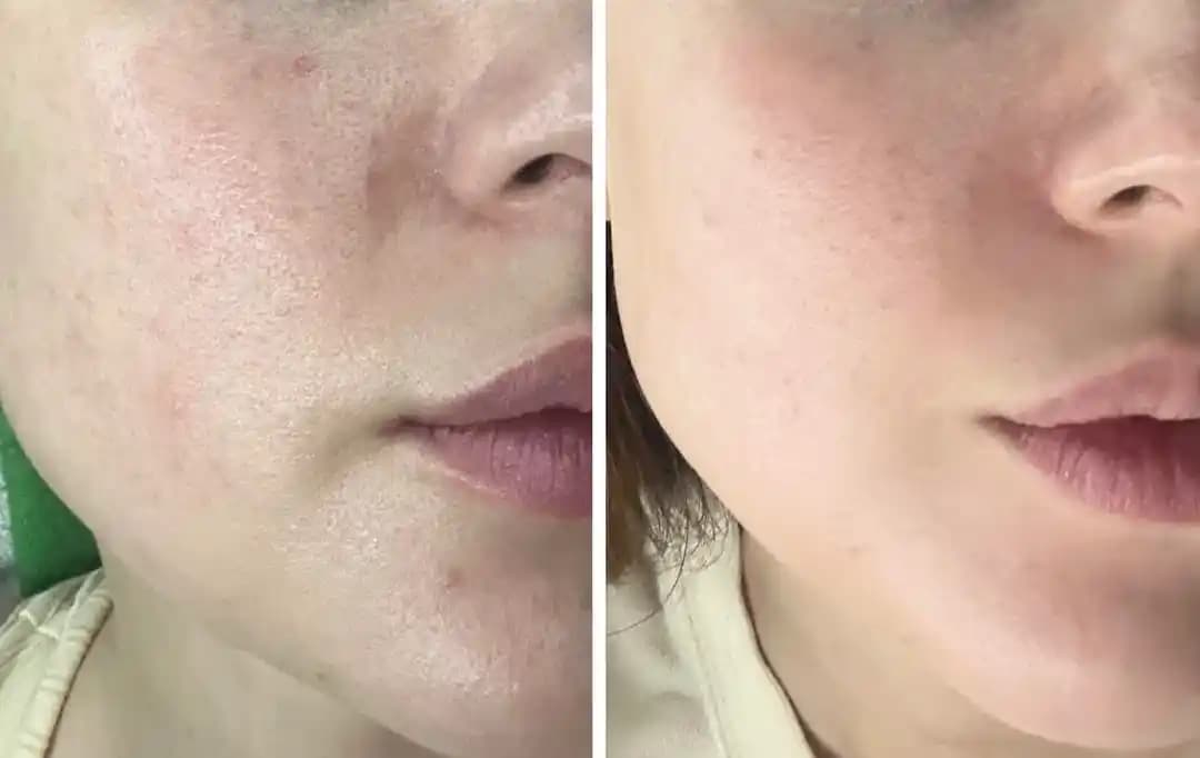 Azelaik Asit ve Laktik Asit Kombinasyonunun Cilt Bakımındaki Etkileri ve Kullanım Rehberi