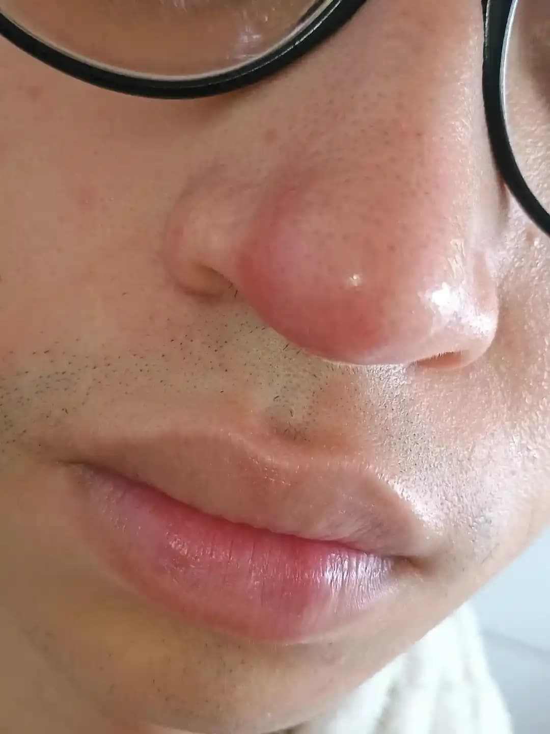 Burundaki Ağrılı Kör Sivilce ve Nazal Vestibülit: Tanı ve Etkili Tedavi Yöntemleri