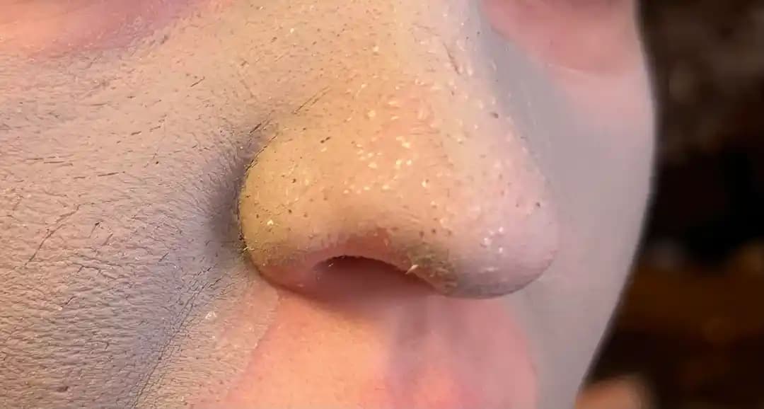 Burundaki Küçük Sıvı Damlacıklarının Nedenleri ve Etkili Cilt Bakım Yöntemleri