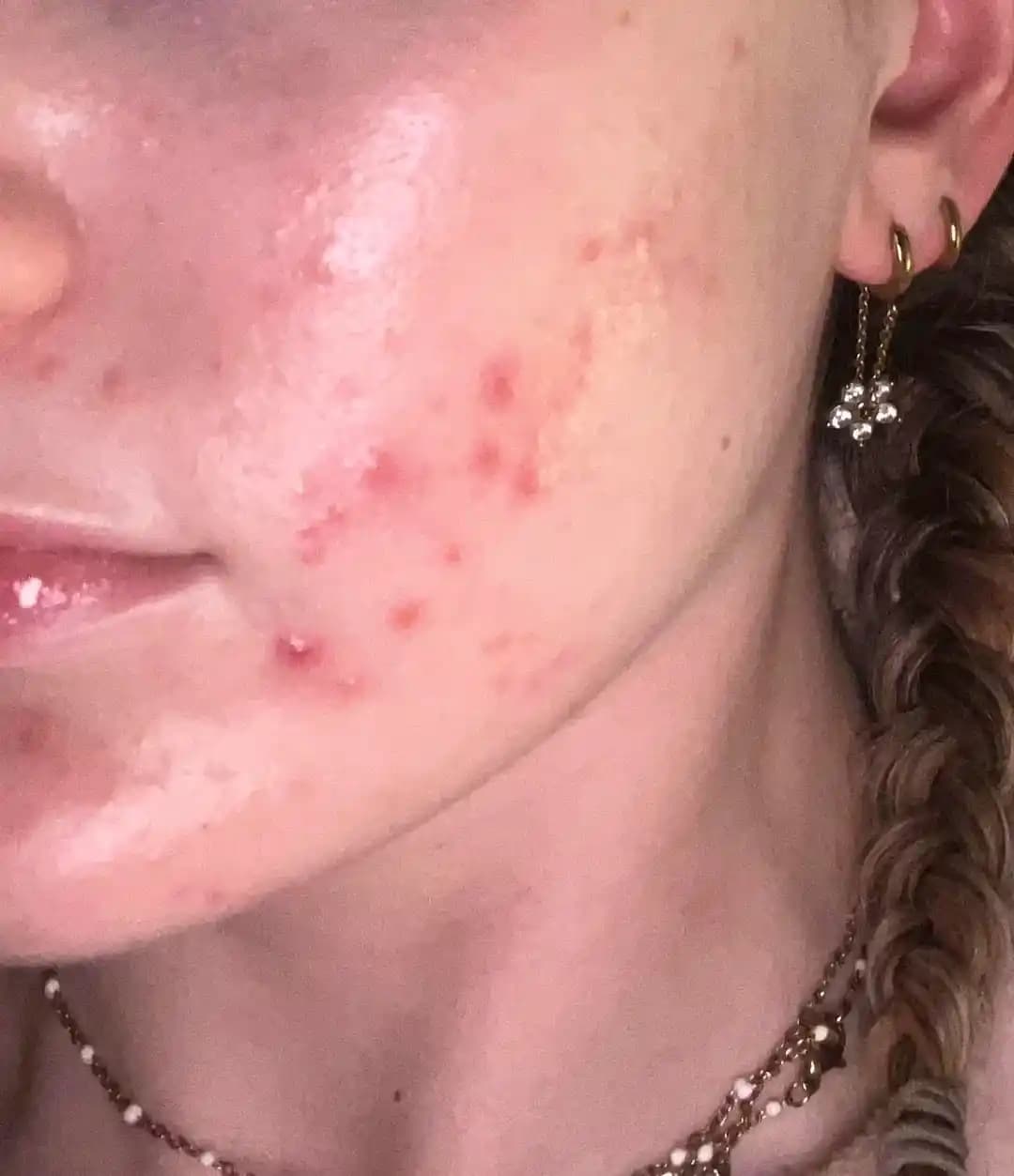 Cerave Oil Cleanser ve Akne İlişkisi: Cilt Tipine Göre Etkiler ve Kullanıcı Deneyimleri