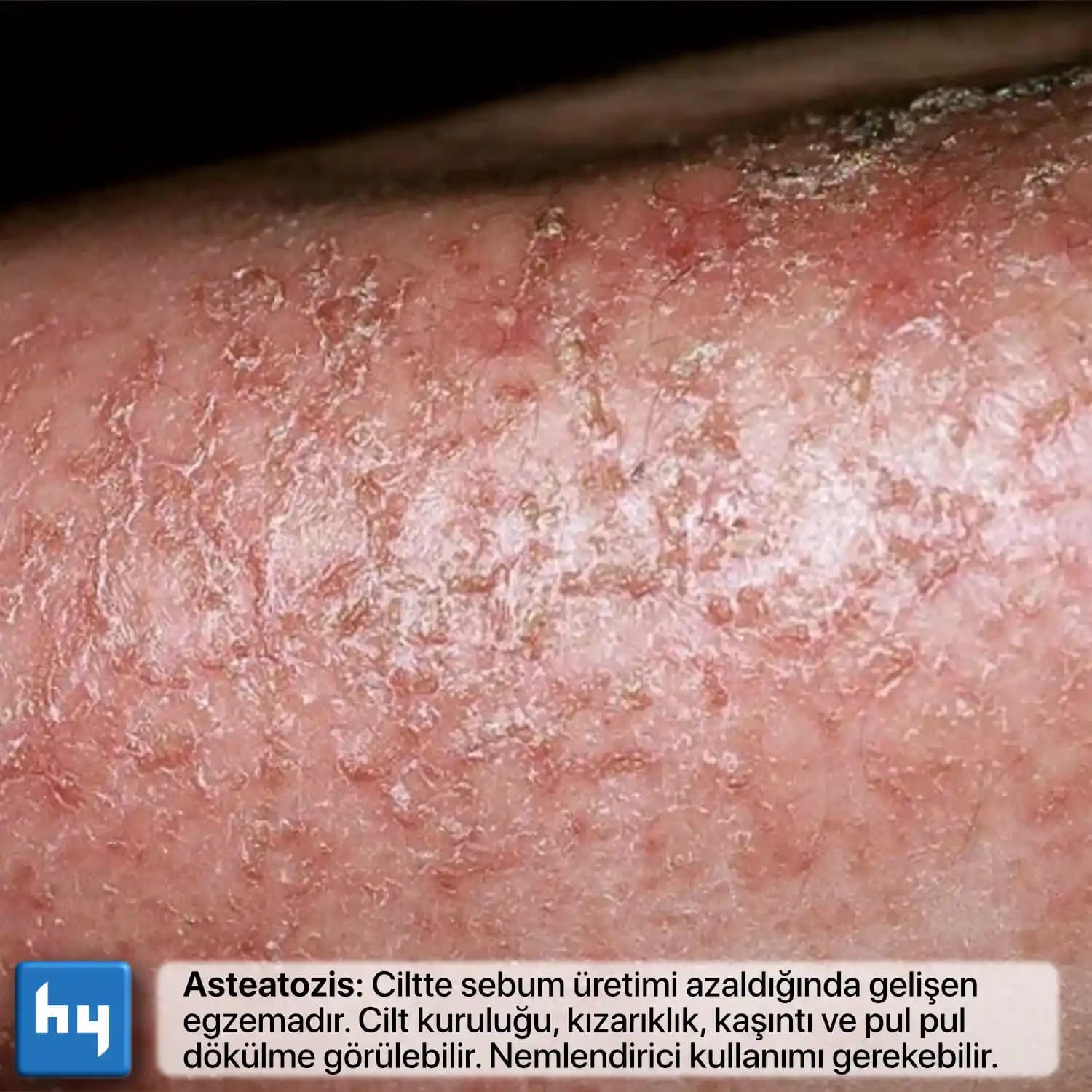 Ciltte Kızarıklık ve Pürüzsüzlük İçin Etkili ve Uygulanabilir Bakım Yöntemleri