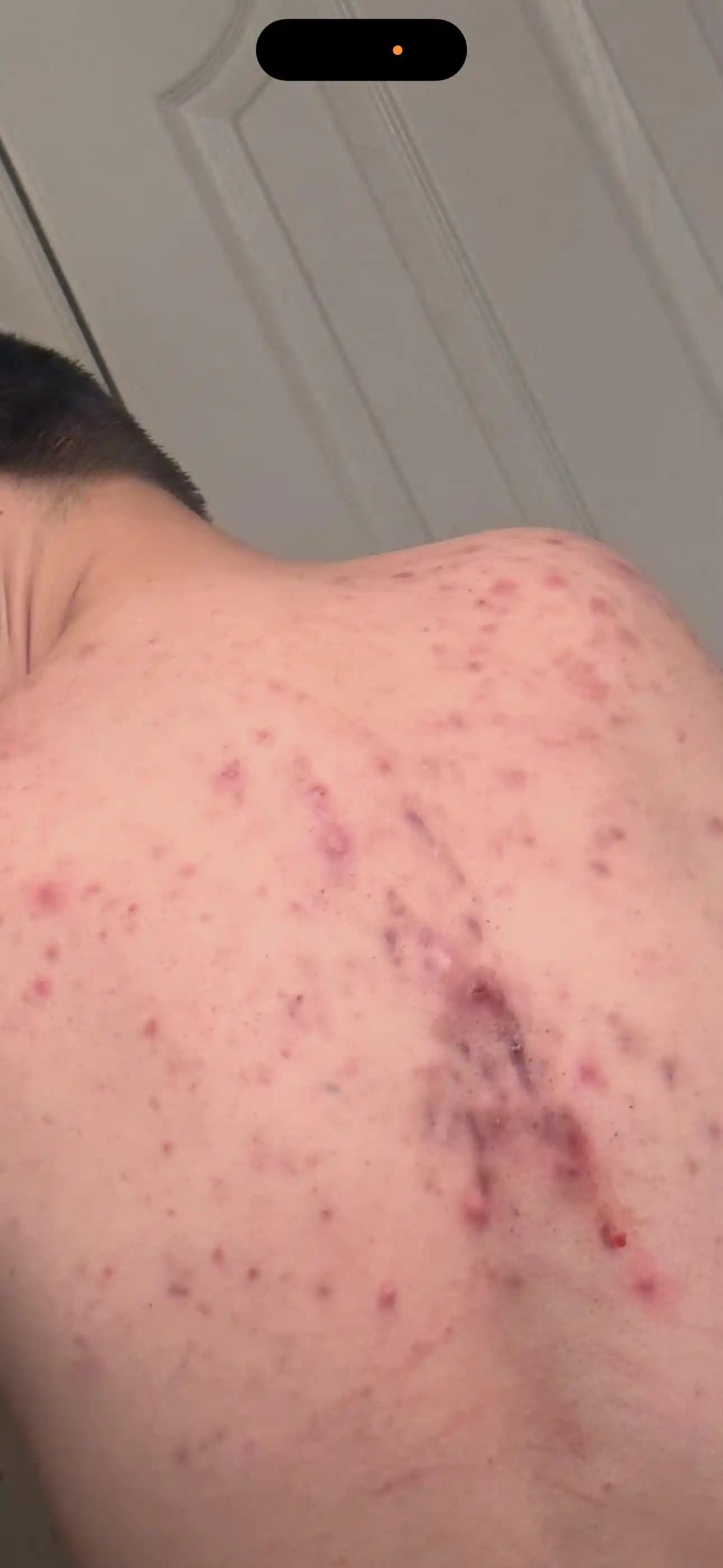 Derin ve Kistik Sırt Aknesi Tedavisinde Uzman Görüşleri ve Etkili Yöntemler