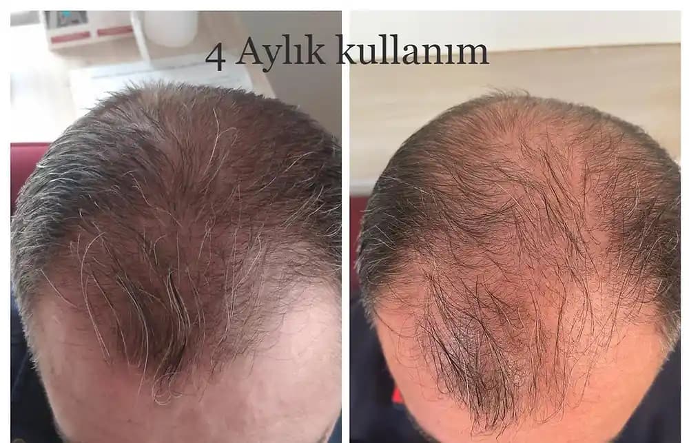 Duş Başlığı Su Filtreleri, Kloramin ve Sert Suyun Saç Sağlığı Üzerindeki Etkileri