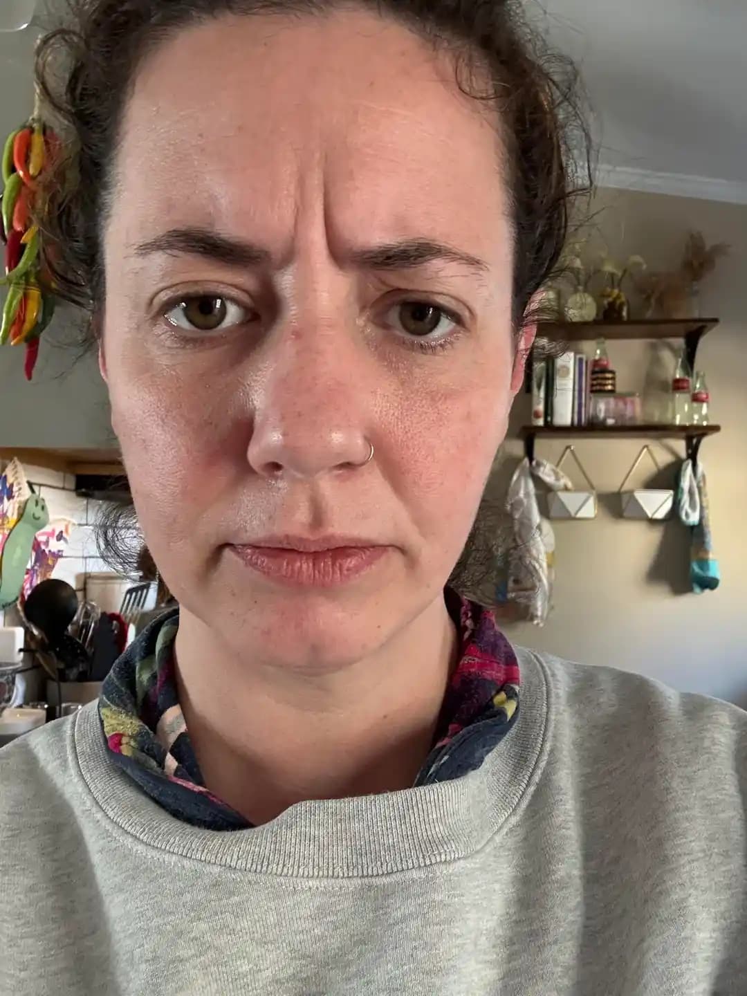 Dysport Enjeksiyonlarının 11 Çizgileri Üzerindeki Etkisi ve Bekleme Süreci Detayları