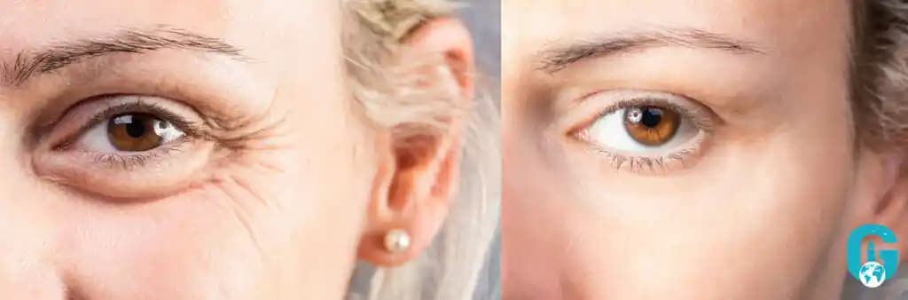 Göz Altı Torbaları ve Morlukları: Ameliyatsız Nedenler ve Etkili Çözümler