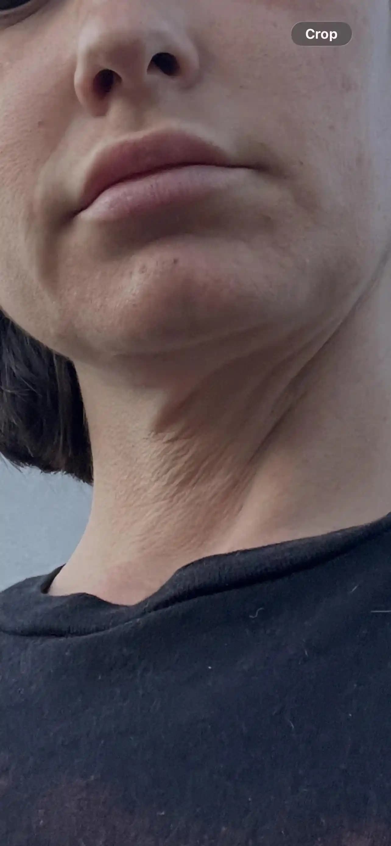 Kilo Kaybı Sonrası Boyun Cildinde Gevşeme ve Bakım Yöntemleri: Etkiler ve Çözümler