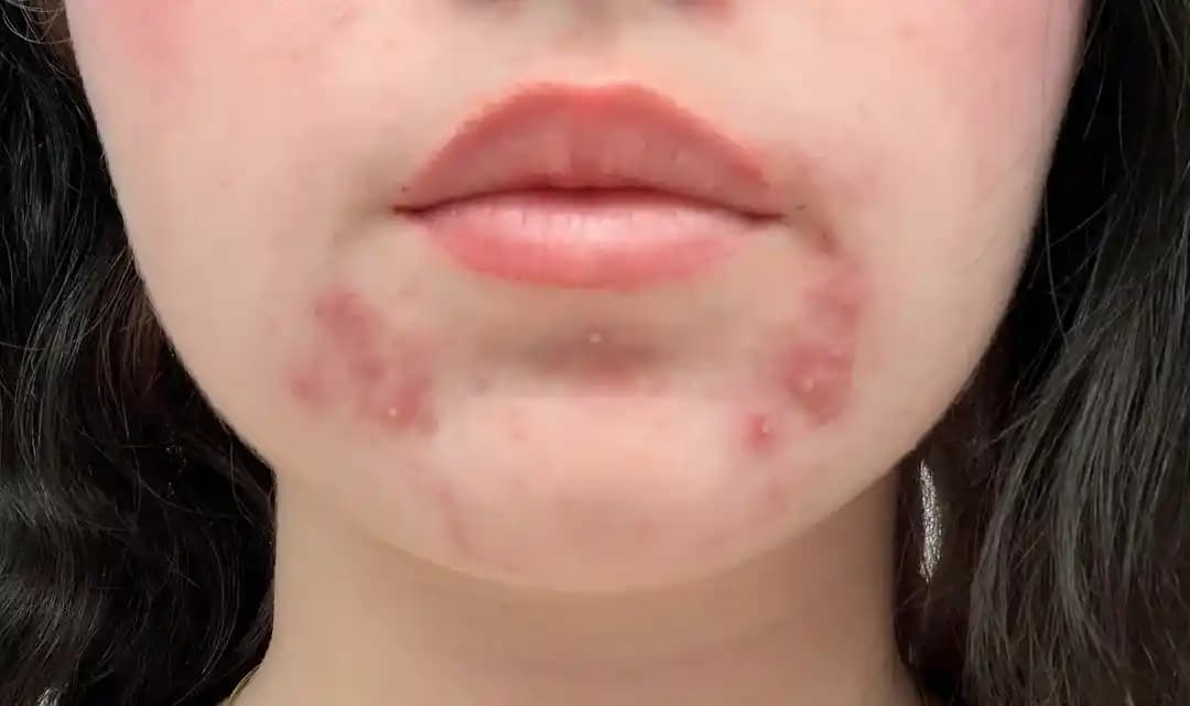 Perioral Dermatit ve Hormonal Aknenin Nedenleri, Tedavi Yöntemleri ve Cilt Bakımı