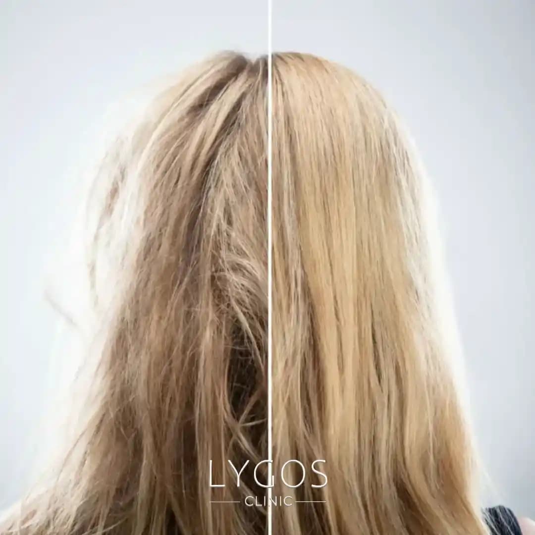 Saç Porozitesi: Ölçümü, Önemi ve Saç Bakımındaki Rolü Üzerine Kapsamlı İnceleme